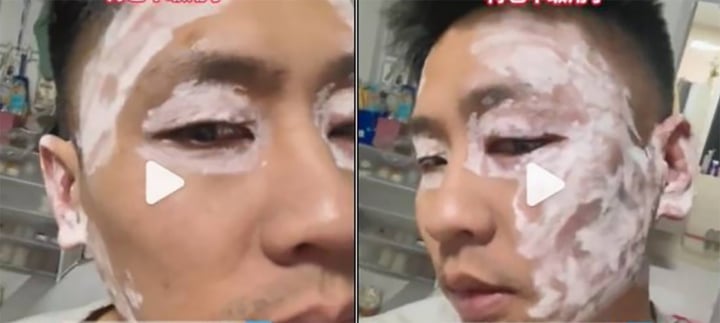 Mặt sưng vù sau khi lau bằng khăn giấy ở nhà hàng- Ảnh 1. Mặt sưng vù sau khi lau bằng khăn giấy ở nhà hàng- Ảnh 1.