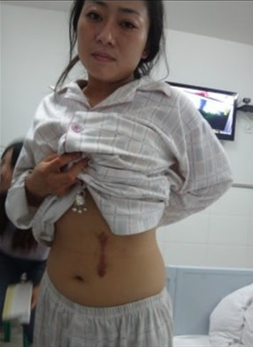 Thai phụ nhận tin 1 quả thận