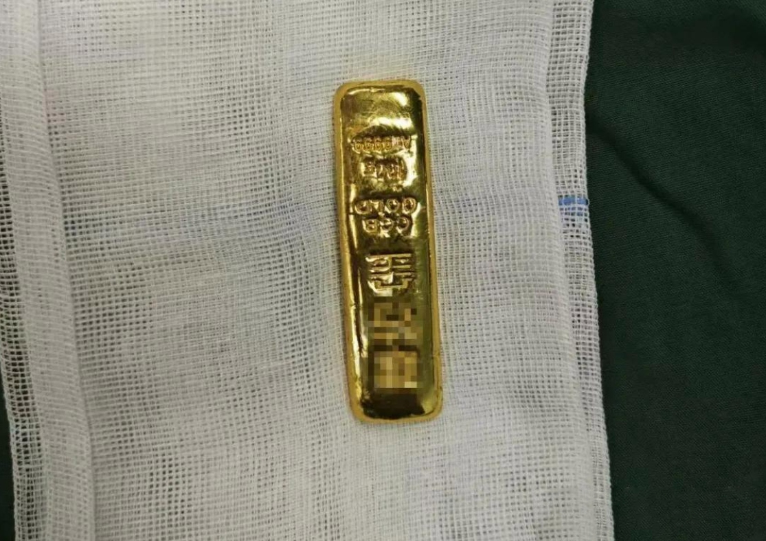 Tò mò, cậu bé 11 tuổi nuốt thỏi vàng vào bụng- Ảnh 2.