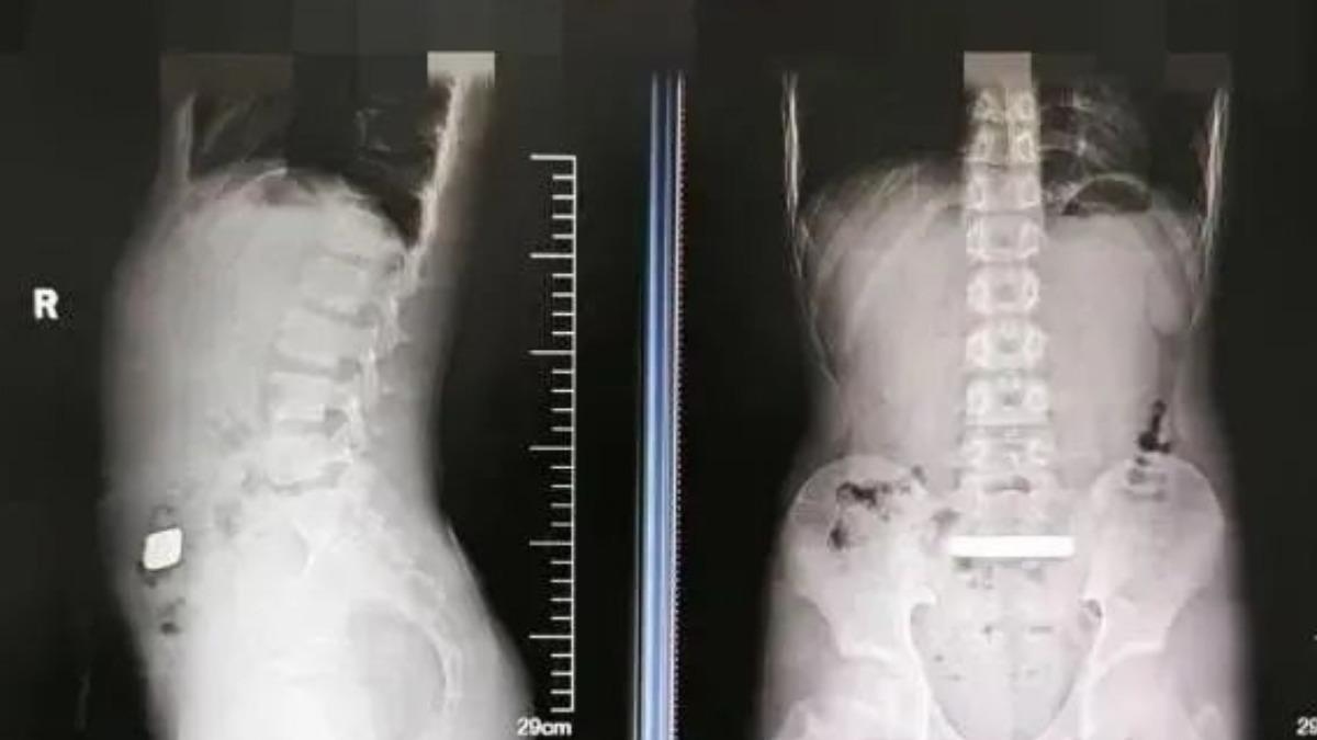 Tò mò, cậu bé 11 tuổi nuốt thỏi vàng vào bụng- Ảnh 1.