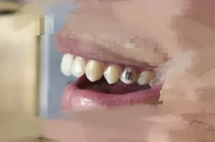 Độc lạ trào lưu xăm răng của giới trẻ Trung Quốc- Ảnh 2.