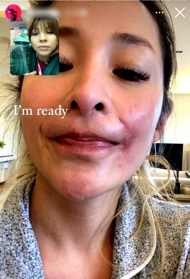 Nữ ca sĩ bị tai nạn đến hủy dung: Vết thương hoại tử 2 tháng, giờ gây sốc với Nữ ca sĩ bị tai nạn đến hủy dung: Vết thương hoại tử 2 tháng, giờ gây sốc với