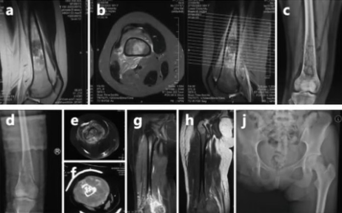 Phim chụp ung thư xương của Thế Vĩ. Ảnh: The Paper