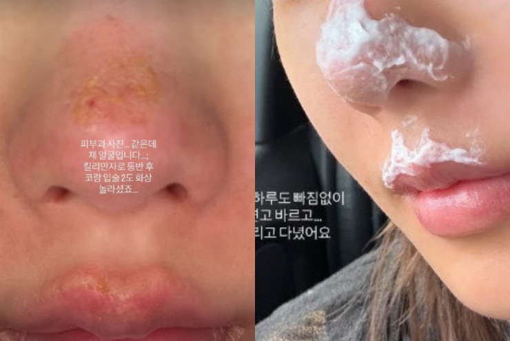 Phần mũi và môi của nữ ca sĩ tổn thương khá nghiêm trọng.