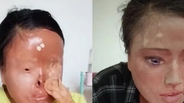 Người phụ nữ tự vẽ mắt, gắn mũi sau bi kịch bị chồng cũ tạt axit adt1768543591 axitt 2785 1540 2904 anh cat 3 2 auto cropjpg