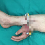 Bác sĩ cứu bàn tay bị đứt lìa của người bệnh bằng cách ghép vào chân avatar1767676519258 1767676519656463339343 50 0 361 498 crop 1767676545867496771858png