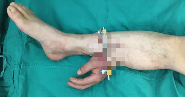 Bác sĩ cứu bàn tay bị đứt lìa của người bệnh bằng cách ghép vào chân avatar1767676519258 1767676519656463339343 50 0 361 498 crop 1767676545867496771858png