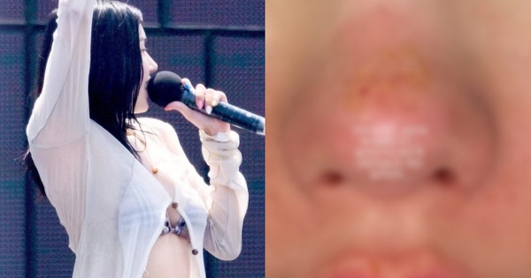 Nữ hoàng gợi cảm showbiz bị bỏng mặt, xót cho nhan sắc trời ban bm1 1770252501952944918520 0 0 351 670 crop 17702525213821579686135jpg