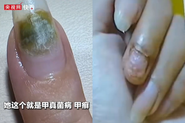 Trung Quốc: Tiệm nail khiến nhiều người nhiễm HPV do khử trùng dụng cụ làm móng qua loa- Ảnh 1.