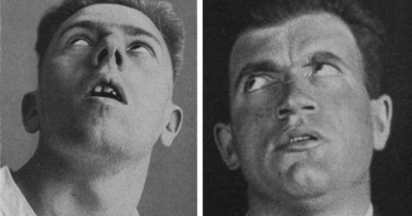 Căn bệnh kỳ lạ đã giết chết 500.000 người rồi đột ngột biến mất encephalitis lethargica 17712318092821232427290 3 0 566 900 crop 1771231911598899017187 1771302301272 17713023013971888060062 0 0 477 764 crop 1771302319982906961207jpg