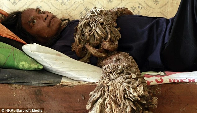 42 năm cuộc đời đầy bi kịch của người cây