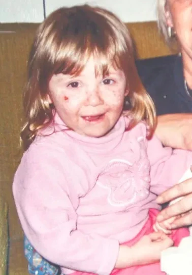 Bi kịch "cô bé ma cà rồng" đời thực