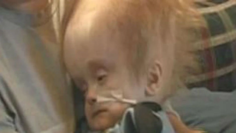 Cậu bé sinh ra không có não sống 12 năm cuộc đời thế nào?