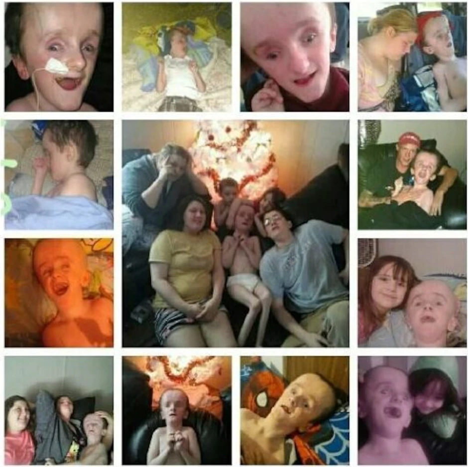 Cậu bé sinh ra không có não sống 12 năm cuộc đời thế nào?