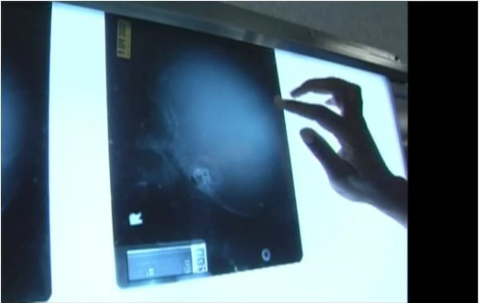 Cậu bé sinh ra không có não sống 12 năm cuộc đời thế nào?