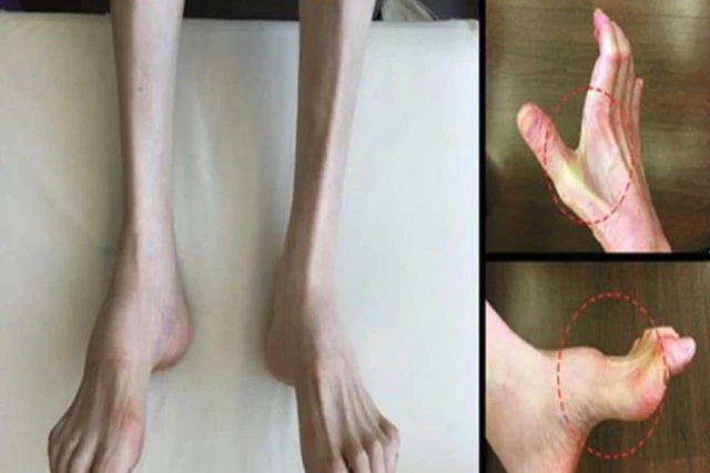 Gia tộc Samsung và căn bệnh di truyền đáng sợ mang tên teo cơ MÁC: Có tất cả nhưng cũng không thể chữa khỏi