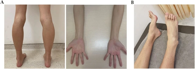 Gia tộc Samsung và căn bệnh di truyền đáng sợ mang tên teo cơ MÁC: Có tất cả nhưng cũng không thể chữa khỏi