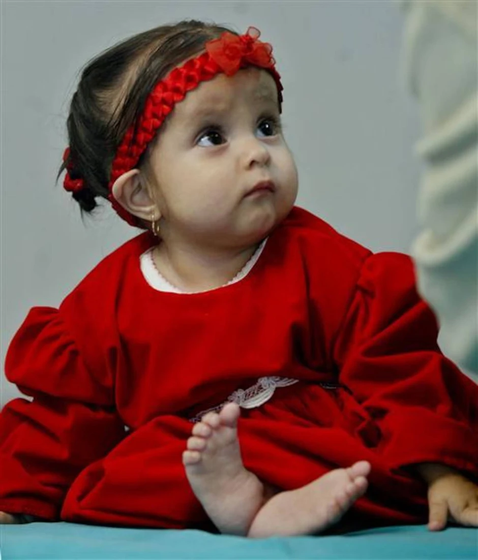 Nàng tiên cá ngoài đời thực: Bé gái chào đời với đôi chân dính liền và 15 năm sống năm phi thường như "một kỳ tích y học"