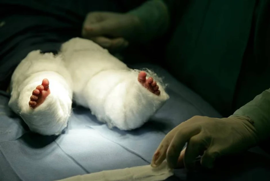 Nàng tiên cá ngoài đời thực: Bé gái chào đời với đôi chân dính liền và 15 năm sống năm phi thường như "một kỳ tích y học"