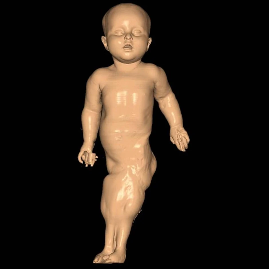 Nàng tiên cá ngoài đời thực: Bé gái chào đời với đôi chân dính liền và 15 năm sống phi thường như "một kỳ tích y học"