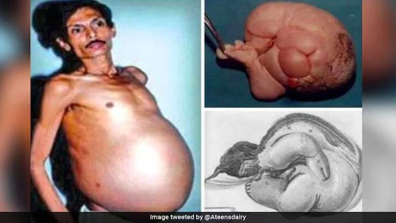 Người đàn ông 60 tuổi mang thai suốt 36 năm, nhóm bác sĩ kinh hoàng khi tiến hành phẫu thuật