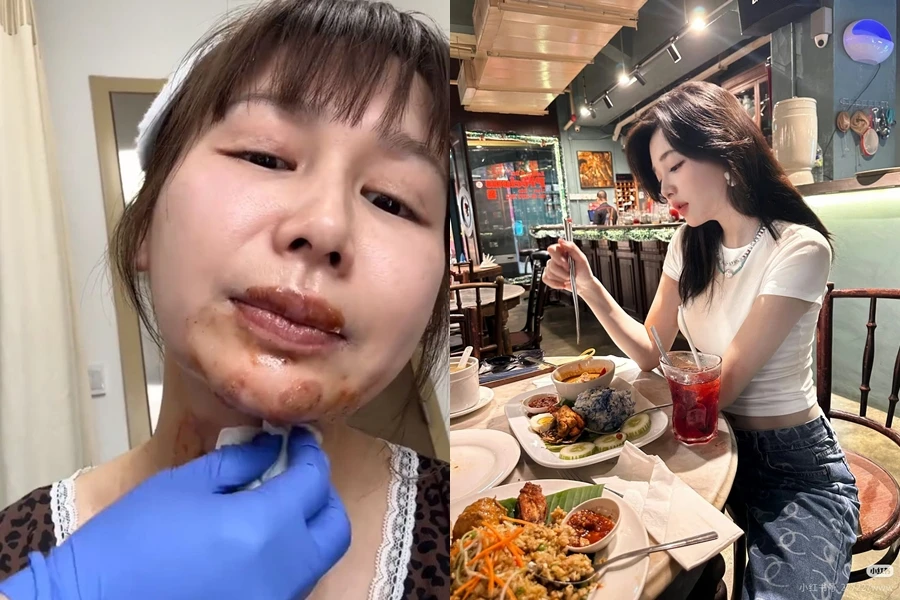 Nữ diễn viên bị bỏng mặt nghiêm trọng trong ngày sinh nhật 27 tuổi do theo trend bánh kem phun lửa