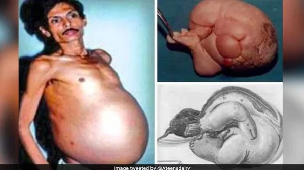 Người đàn ông 60 tuổi mang thai suốt 36 năm, nhóm bác sĩ kinh hoàng khi tiến hành phẫu thuật kenhtingame com thumb nguoi dan ong 60 tuoi mang thai suot 36 nam nhom bac si kinh hoang khi tien hanh phau thuat f3d31773659517839 940w