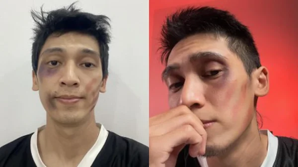 Tronie Ngô bị mặt mũi bầm dập sau khi xin vợ chơi pickleball kenhtingame com thumb tronie ngo bi mat mui bam dap sau khi xin vo choi pickleball 61d51773232718426 940w