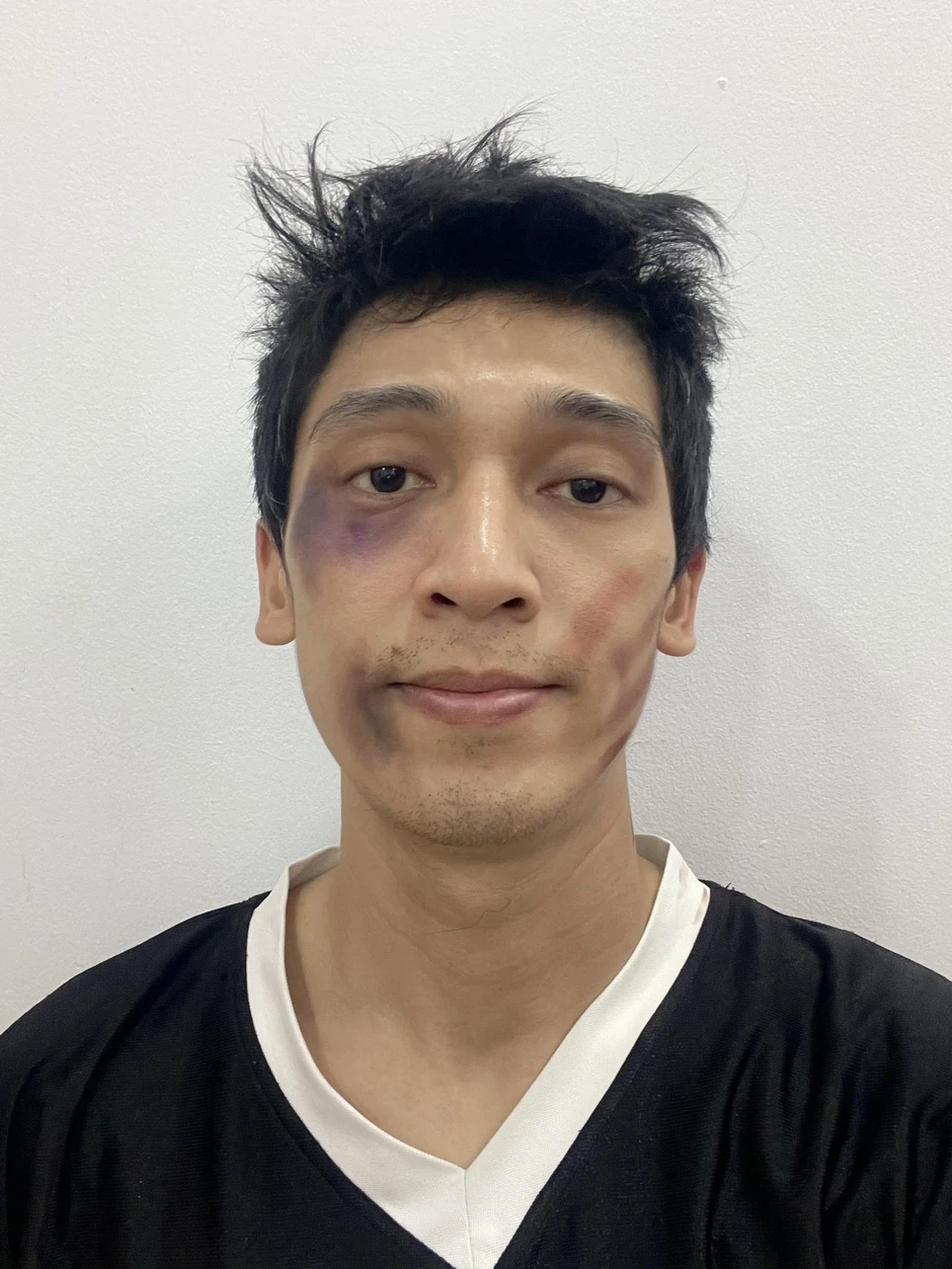 Tronie Ngô lộ diện với khuôn mặt thâm tím sau xin vợ cho chơi pickleball