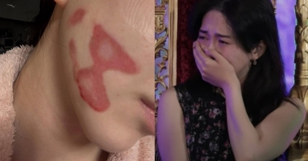 Nữ thần sắc đẹp showbiz bị bỏng mặt nghiêm trọng hậu thẩm mỹ, nhìn tình hình hiện tại mà xót thay kmn11 1770597962043752817393 35 0 385 668 crop 1770597974637889225317jpg