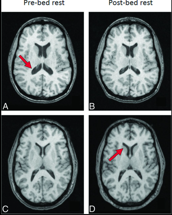 Não phi hành gia 'biến dạng' sau thời gian trên vũ trụ: Ảnh chụp hé lộ khác biệt này so với người thường- Ảnh 2. Não phi hành gia 'biến dạng' sau thời gian trên vũ trụ: Ảnh chụp hé lộ khác biệt này so với người thường- Ảnh 2.