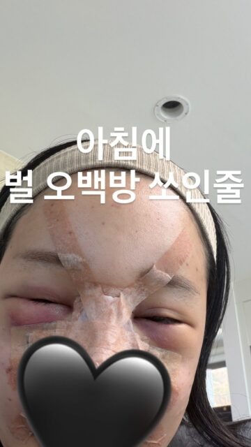 Trùng tu nhan sắc để ăn Tết, 1 sao nữ mặt mũi biến dạng, sưng phồng như bị