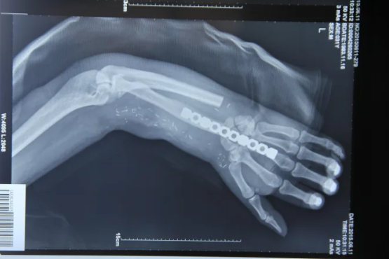 Bác sĩ cứu bàn tay bị đứt lìa của người bệnh bằng cách ghép vào chân- Ảnh 3.