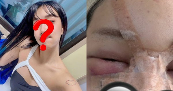 Trùng tu nhan sắc để ăn Tết, 1 sao nữ mặt mũi biến dạng, sưng phồng như bị "500 con ong đốt" thiet ke chua co ten 15 1771504792060838754390 0 0 335 640 crop 1771504802383762457846png