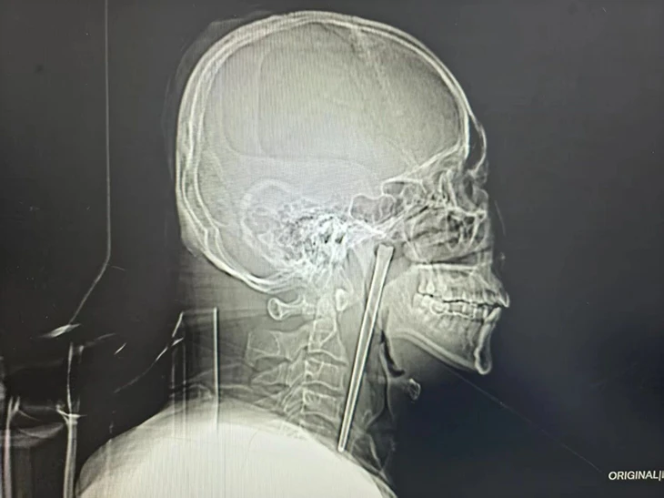 Hy hữu người đàn ông Trung Quốc sống 8 năm với chiếc đũa kim loại mắc trong cổ họng