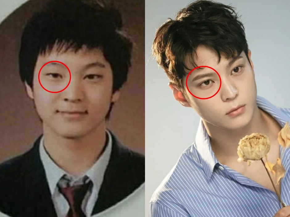 Mỹ nam tốn cả đống tiền “dao kéo”, nay bỗng gặp phải tình trạng mắt bên 1 mí - bên 2 mí