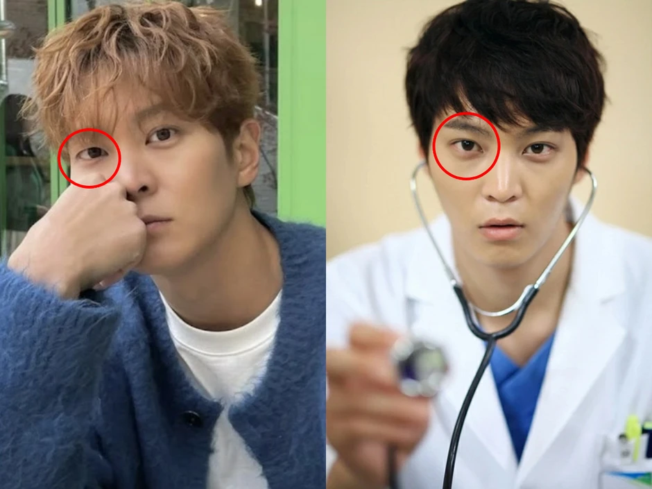 Mỹ nam tốn cả đống tiền “dao kéo”, nay bỗng gặp phải tình trạng mắt bên 1 mí - bên 2 mí