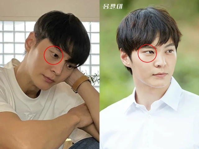 Mỹ nam tốn cả đống tiền “dao kéo”, nay bỗng gặp phải tình trạng mắt bên 1 mí - bên 2 mí