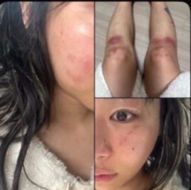 Nữ ca sĩ yêu lại bạn trai cũ từng đánh cô bầm dập toàn thân: “Tôi không kiện anh ấy nữa”