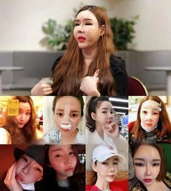 Sao chuyển giới chi 2,5 tỷ "dao kéo" toàn bộ gương mặt, 2 lần chia tay bạn trai trong nước mắt vì không thể sinh con