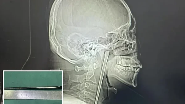 Hy hữu người đàn ông Trung Quốc sống 8 năm với chiếc đũa kim loại mắc trong cổ họng kenhtingame com thumb hy huu nguoi dan ong trung quoc song 8 nam voi chiec dua kim loai mac trong co hong 1a341776690323252 940w