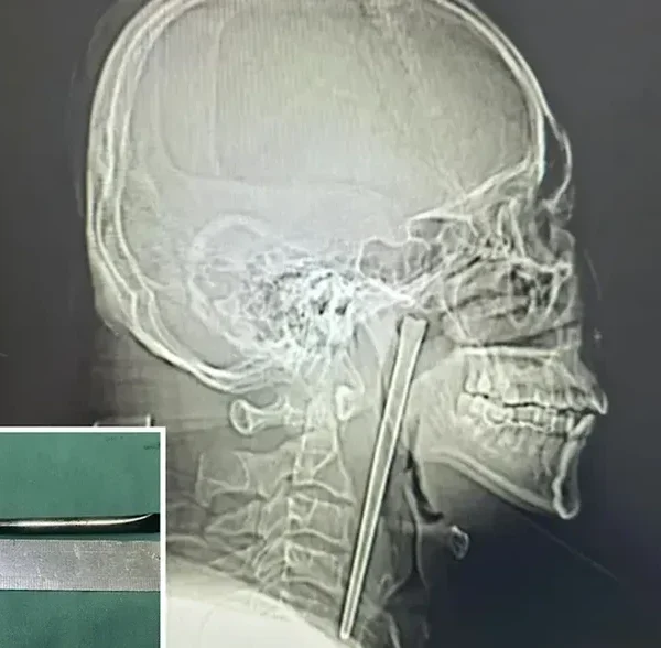 Hy hữu người đàn ông Trung Quốc sống 8 năm với chiếc đũa kim loại mắc trong cổ họng kenhtingame com thumb hy huu nguoi dan ong trung quoc song 8 nam voi chiec dua kim loai mac trong co hong 1a341776690323252 940w