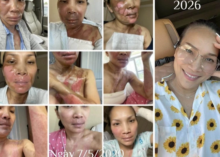Ca sĩ đình đám của showbiz Việt một thời khoe nhan sắc rạng rỡ sau 6 năm bị bỏng nặng vì nồi xông hơi phát nổ