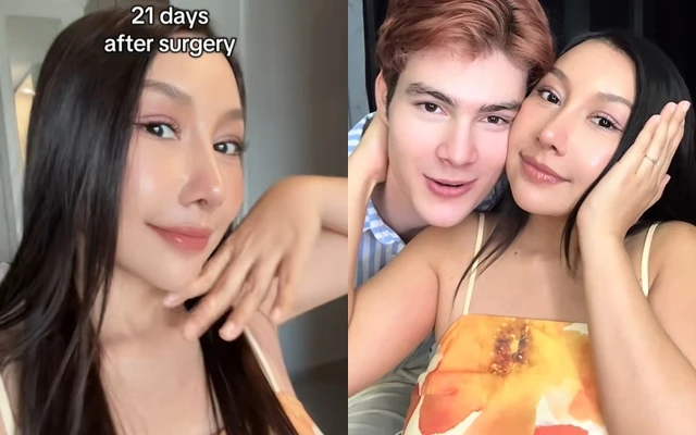Gương mặt sau 21 ngày phẫu thuật thẩm mỹ của cô vợ cao 1m55 áp lực vì chồng Tây quá đẹp trai, cao gần 2m Gương mặt sau 21 ngày phẫu thuật thẩm mỹ của cô vợ cao 1m55 áp lực vì chồng Tây quá đẹp trai, cao gần 2m