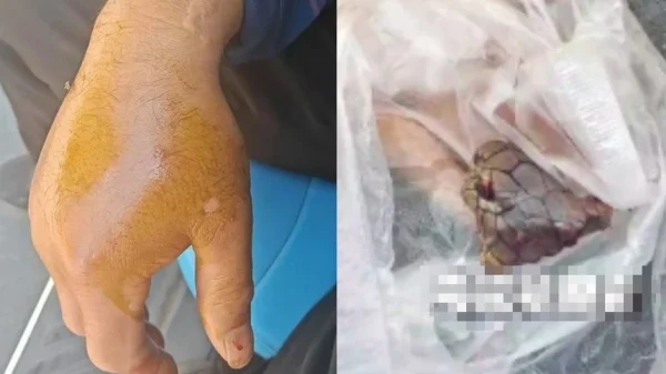 Bị rắn hổ mang chúa dài 2 mét cắn, người đàn ông chém đứt xác rắn rồi đến bệnh viện kenhtingame com thumb bi ran ho mang chua dai 2 met can nguoi dan ong chem dut xac ran nbsp roi den benh vien bf851778761793721 940w