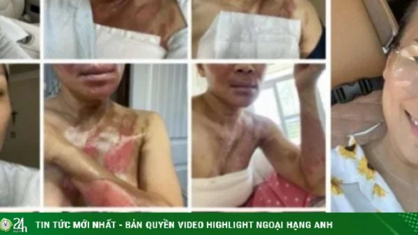 Ca sĩ đình đám của showbiz Việt một thời khoe nhan sắc rạng rỡ sau 6 năm bị bỏng nặng vì nồi xông hơi phát nổ kenhtingame com thumb ca si dinh dam cua showbiz viet mot thoi khoe nhan sac rang ro sau 6 nam bi bong nang vi noi xong hoi phat no 3cac1778286989081 940w