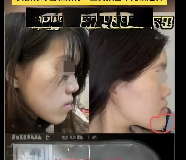 Cô gái bị biến dạng khuôn mặt sau PTTM, bi kịch đau khổ vì quyết định sai lầm Cô gái bị biến dạng khuôn mặt sau PTTM, bi kịch đau khổ vì quyết định sai lầm