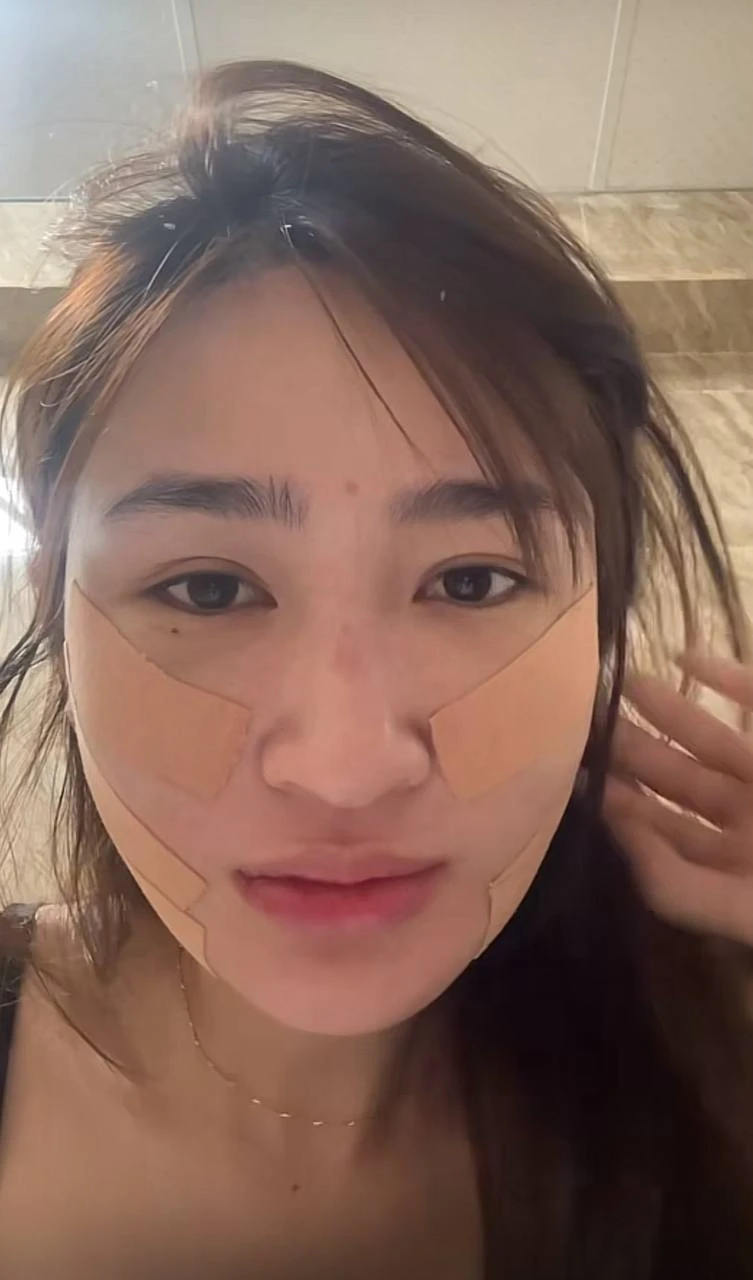 Mỹ nhân SN 2001 đóng phim giờ vàng VTV công khai dung mạo sau khi hút mỡ mặt