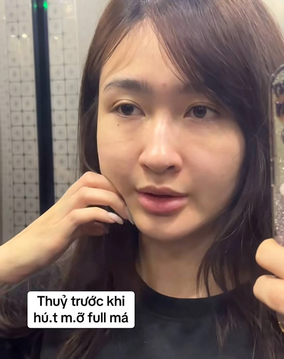 Mỹ nhân SN 2001 đóng phim giờ vàng VTV công khai dung mạo sau khi hút mỡ mặt